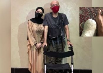 “Bukan Bala, Cuma Ujian-Nya” – Bad Indigo Kehilangan Lima Jari Kaki Akibat Gangren